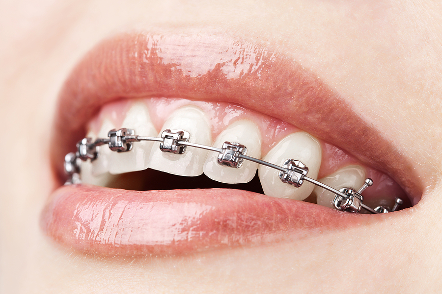 Transforming Smiles with Metal Braces: A Proven Orthodontic Solution