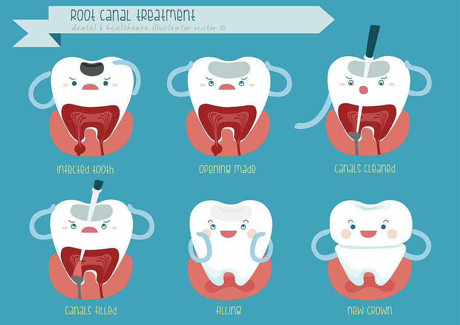 Root Canals: Saving Your Natural Teeth with Modern Dentistry